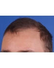 After Hair Transplant&nbsp;Front